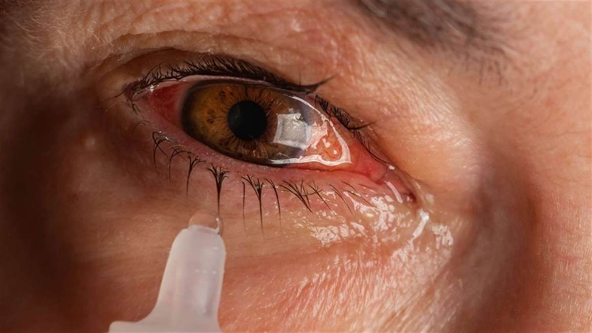 إنفلونزا العيون