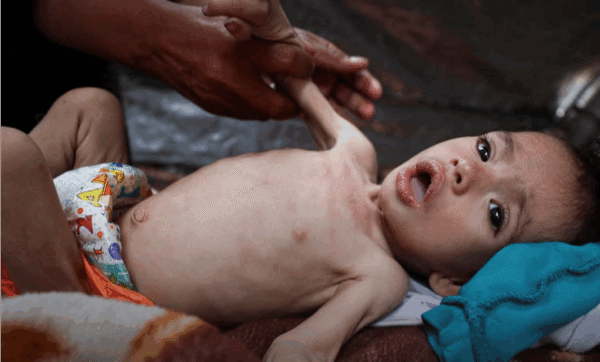 أطباء غزة يحذرون من تفشي “الحمى الشوكية” وخروجه عن السيطرة