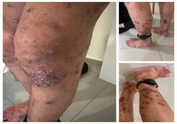 برد قارس داخل الزنازين مع تفشي الجرب بين الأسرى الفلسطينيين في سجن جلبوع