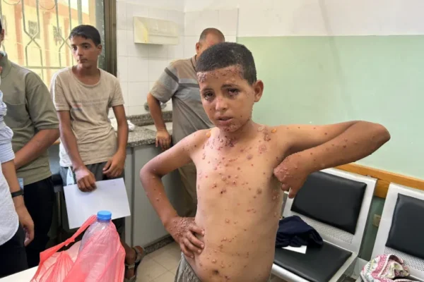 الجرذان تزيد الالتهابات الجلدية في غزة