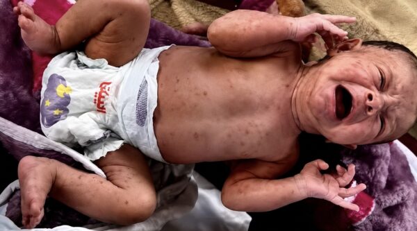 “جدري الماء”.. من بثور عابرة إلى وباء يفتك بـ53 ألف طفل ورضيع في غزة