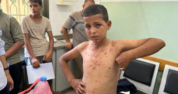 الجدري والجرب والتقمل.. إصابة 9300 فلسطيني بأمراض جلدية معدية خلال أسبوعين في غزة